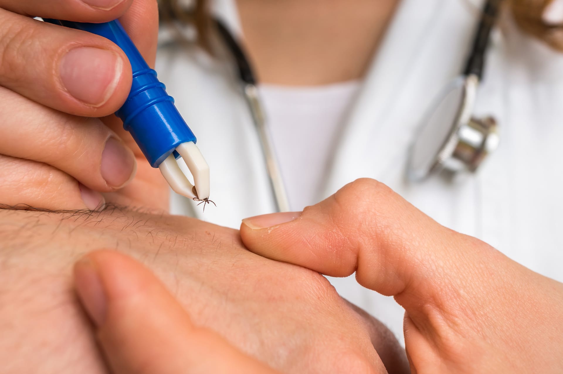 Person using a blue tick removal tool to remove a tick from skin