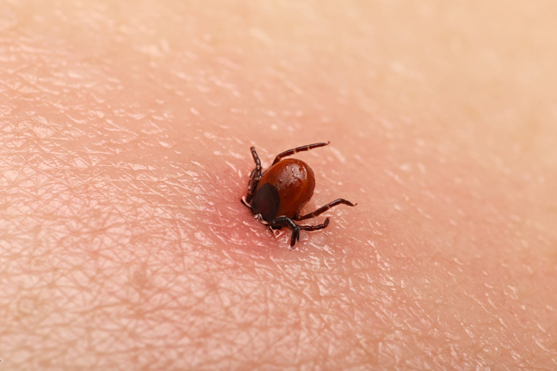 Tick attached to human skin with visible redness around the bite area