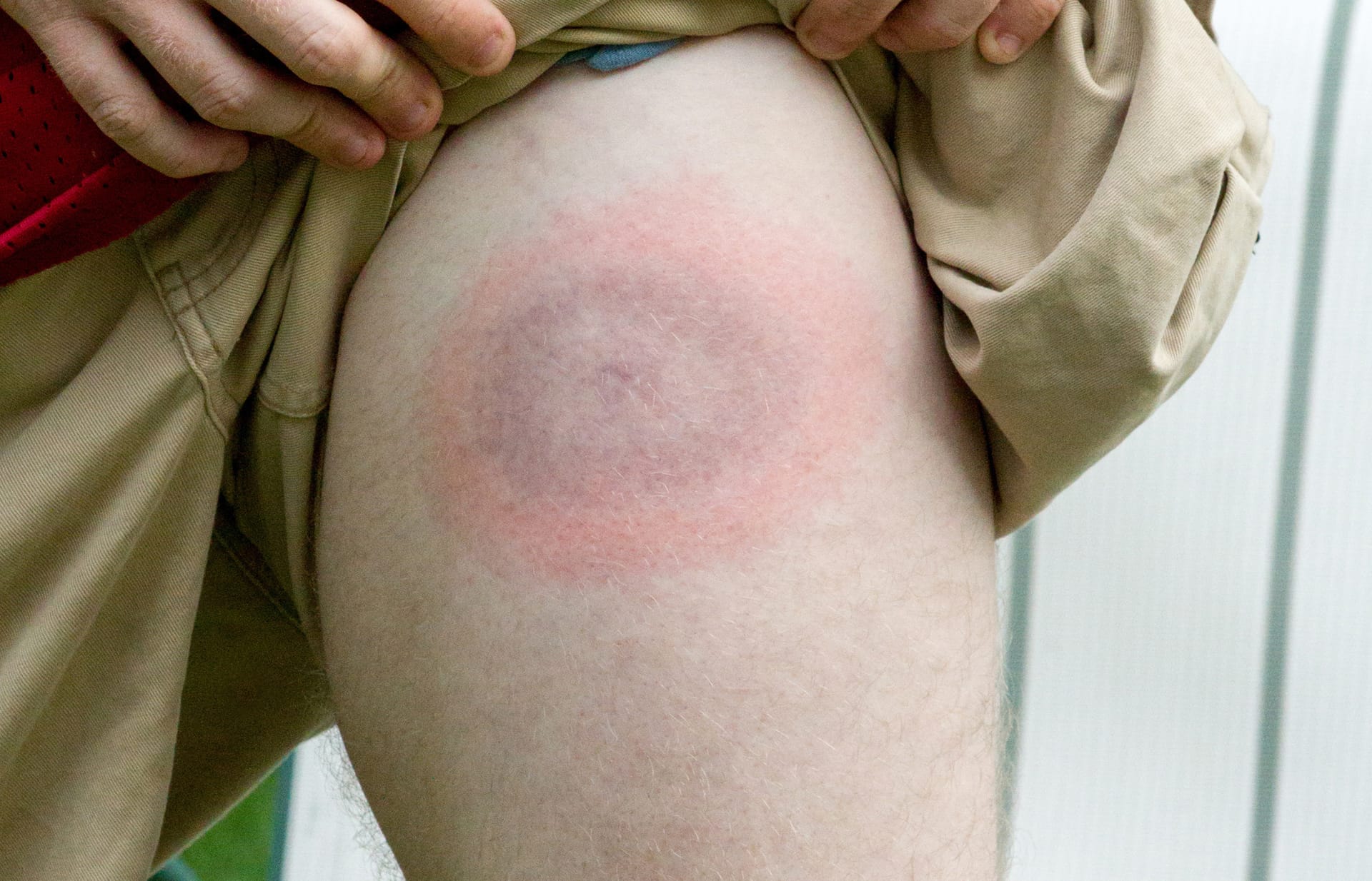 Bullseye rash on skin with a large red ring and darker center